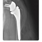 Premieră medicală la SJUP (1)