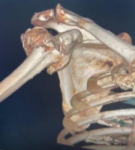 Premieră medicală la SJUP (4)